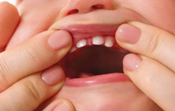 صورة لبداية ظهور الأسنان اللبنية